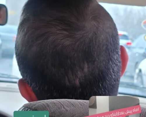 روغن فندق مناسب رویش مجدد مو